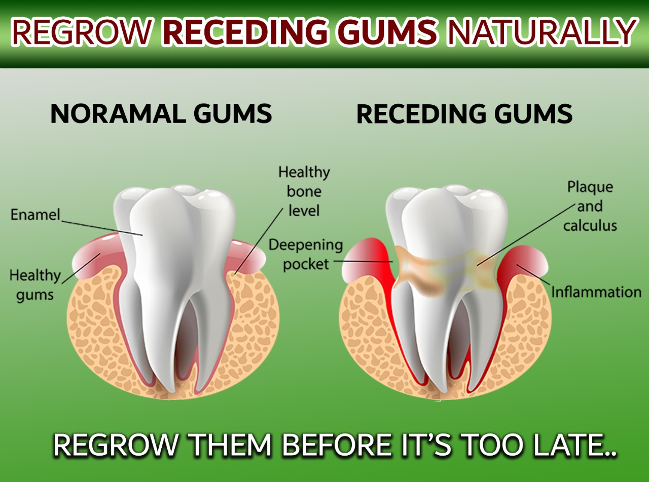How to Heal Gums Naturally